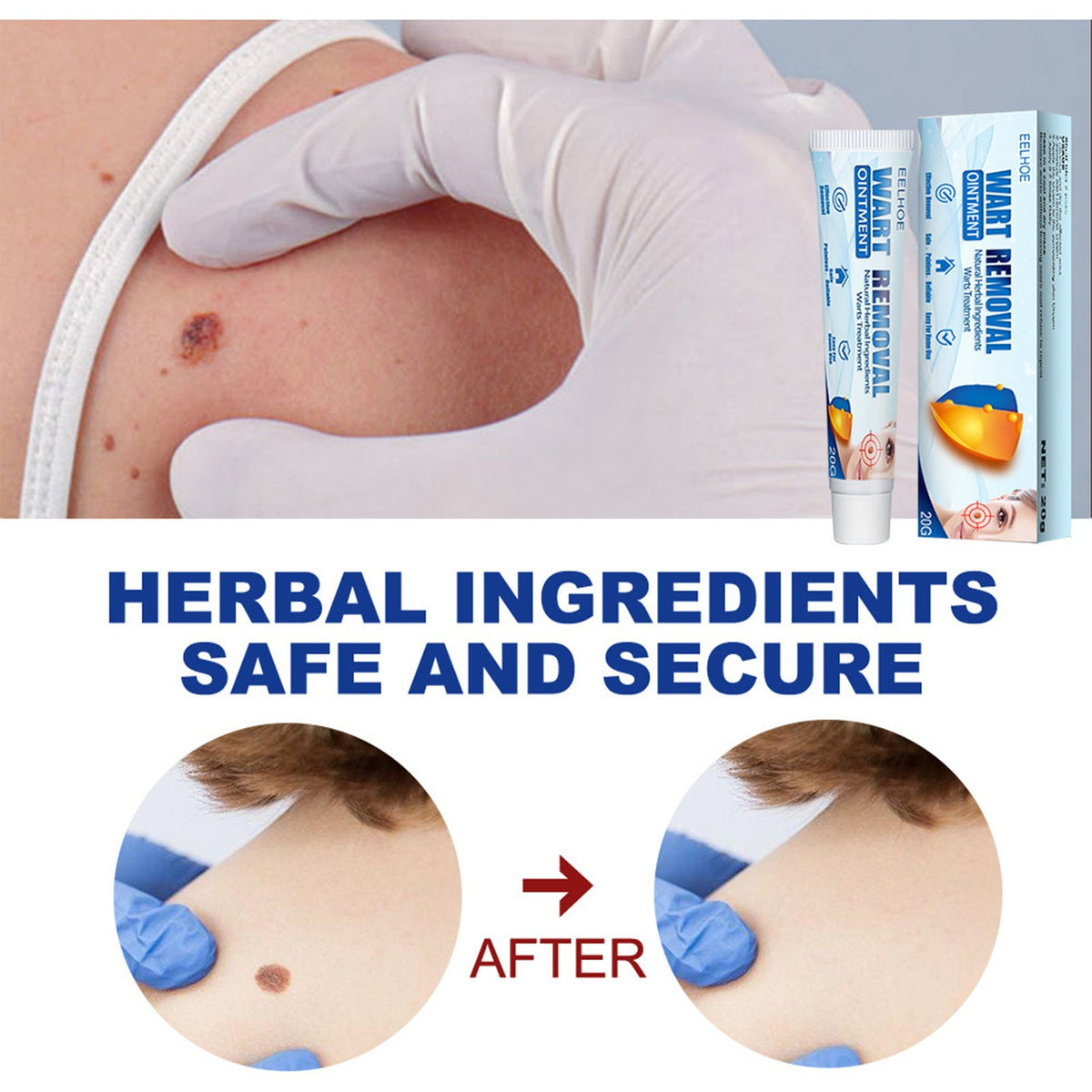 EELHOE Skin Repair Cream – Wart & Blemish Removal Cleansing Cream